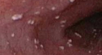 pomada ginecologica para candidiase e tricomoniase