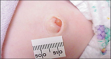 Tratamento: Granuloma do coto umbilical