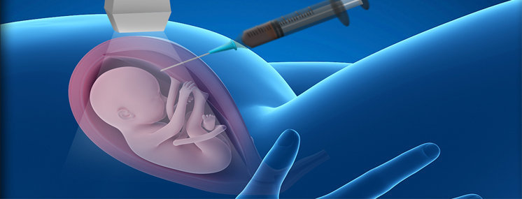 Amniocentese riscos e vantagens