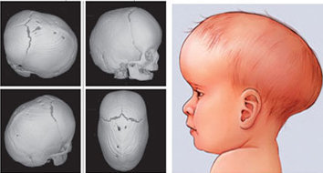 A moleira do bebe e os riscos da cranioestenose