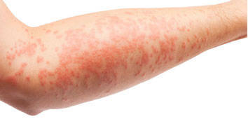 Dermatite atópica- causas, tratamento e prevenção