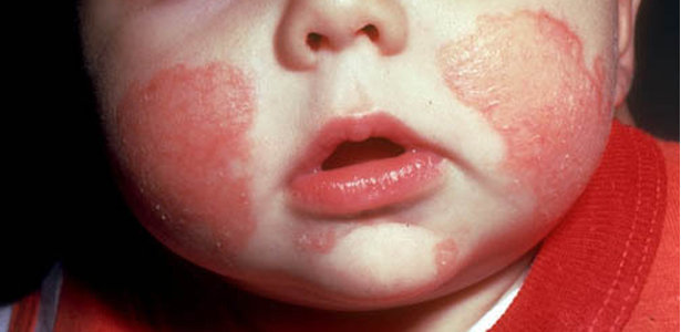 eczema bebe