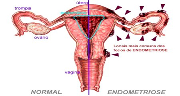 Tipos de endometriose,causa, sintomas e tratamento.