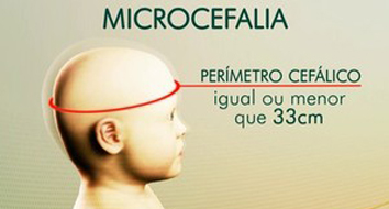 Microcefalia: tratamento, causas e prevenção