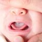 Sapinho (candida albicans) nos bebes, como tratar! Sapinho (candida albicans) nos bebes, como tratar!