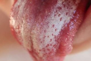 Sapinho (candida albicans) nos bebes, como tratar! Sapinho (candida albicans) nos bebes, como tratar!