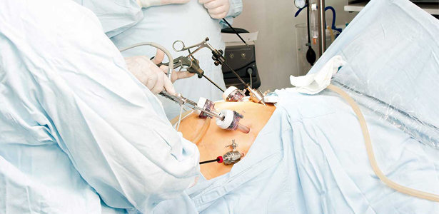 Cirurgia laparoscópica
