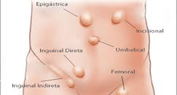 Tipos de hérnias: sintomas e tratamento