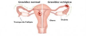 Mortalidade-por-gravidez-ectópica