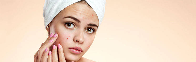 Tratamento de acne na adolescencia